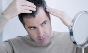تساقط الشعر والصلع
