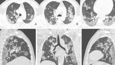 رئة مريض كورونا