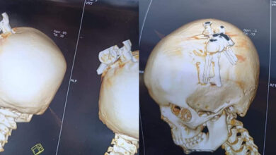 أشعة تظهر المفتاح في جمجمة الضحية